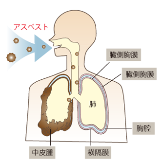 アスベストによる健康被害